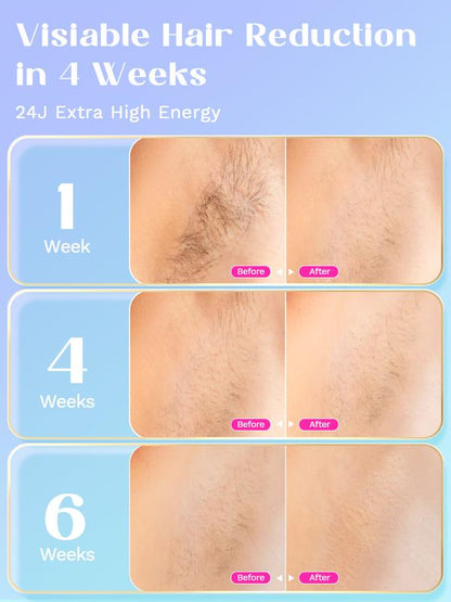 IPL Hair Removal with Ice Cooling Function, 24J High Energy Corded Laser for Body and Bikini