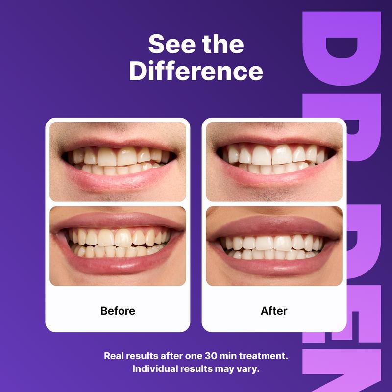 Purple Teeth Whitening Strips - 7/21 Sessions - Non-Sensitive & Peroxide-Free