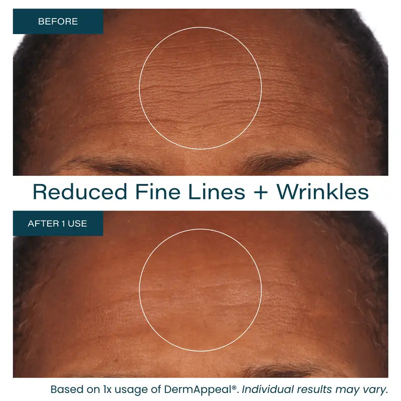 Microdermabrasion Facial Exfoliate Treatment with Advanced Crystal Technology for All Skin Types