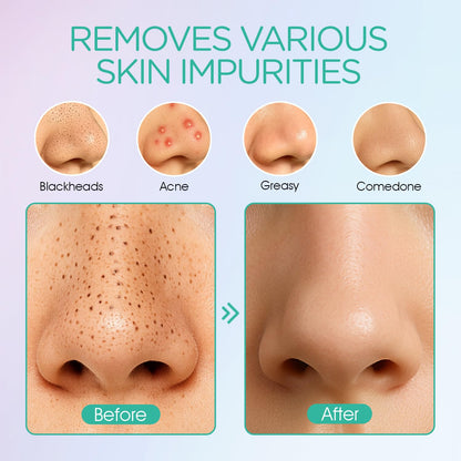 Blackhead Remover Pore Vacuum - Electric Face Cleaner with 6 Suction Heads